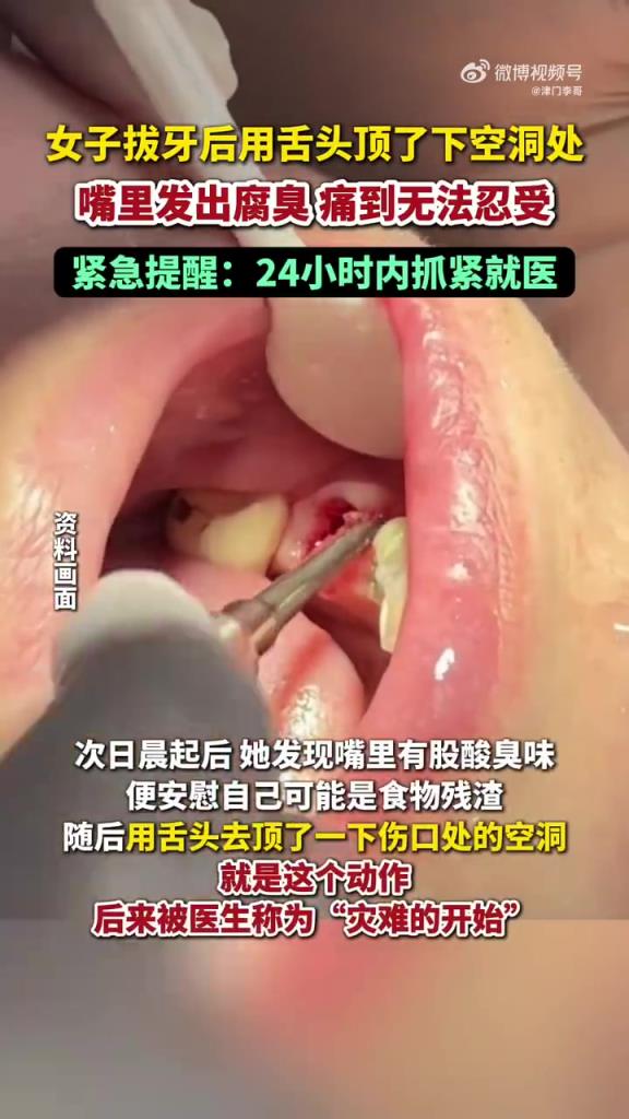 女子拔牙后顶牙洞剧痛，紧急提醒及时就医