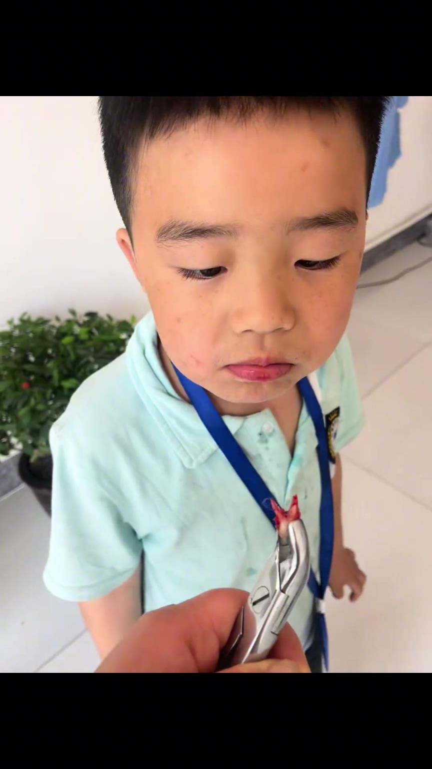 勇敢的小孩哥自己拔牙。