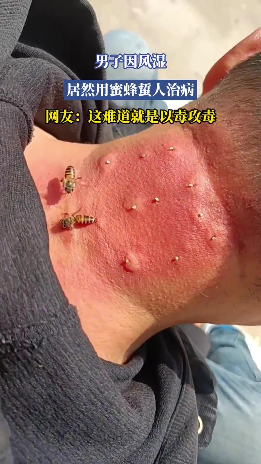 男子因风湿,居然用蜜蜂蜇人治病?网友:这难道就是以毒攻毒!!!