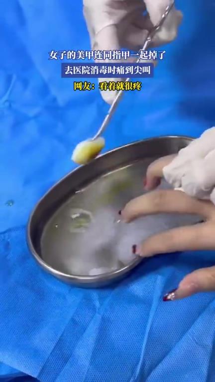 女子美甲连指甲掉落，医院消毒痛到尖叫