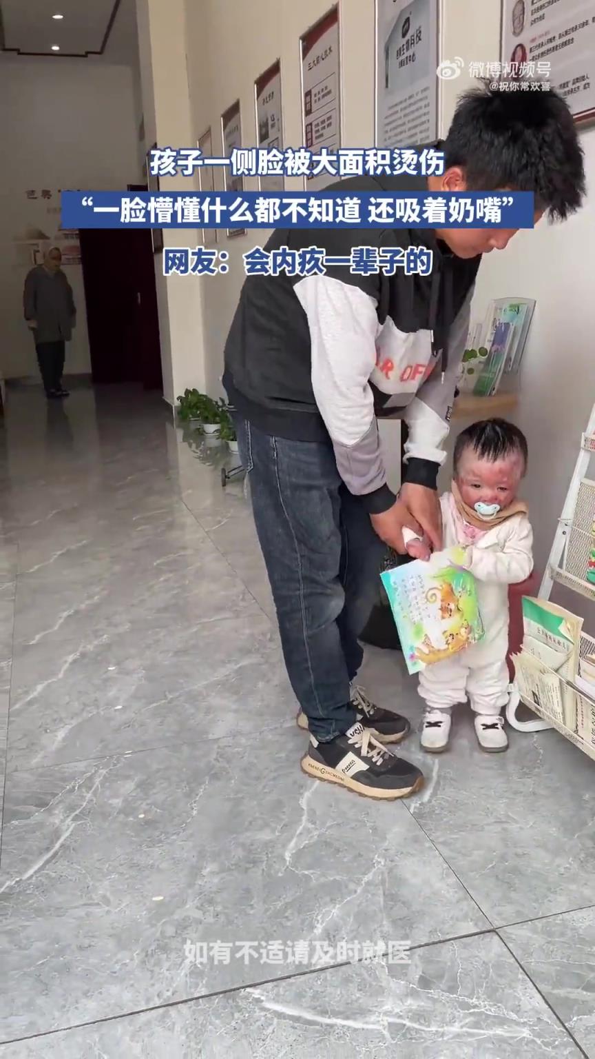 孩子一侧脸大面积烫伤，懵懂状态还吸着奶嘴