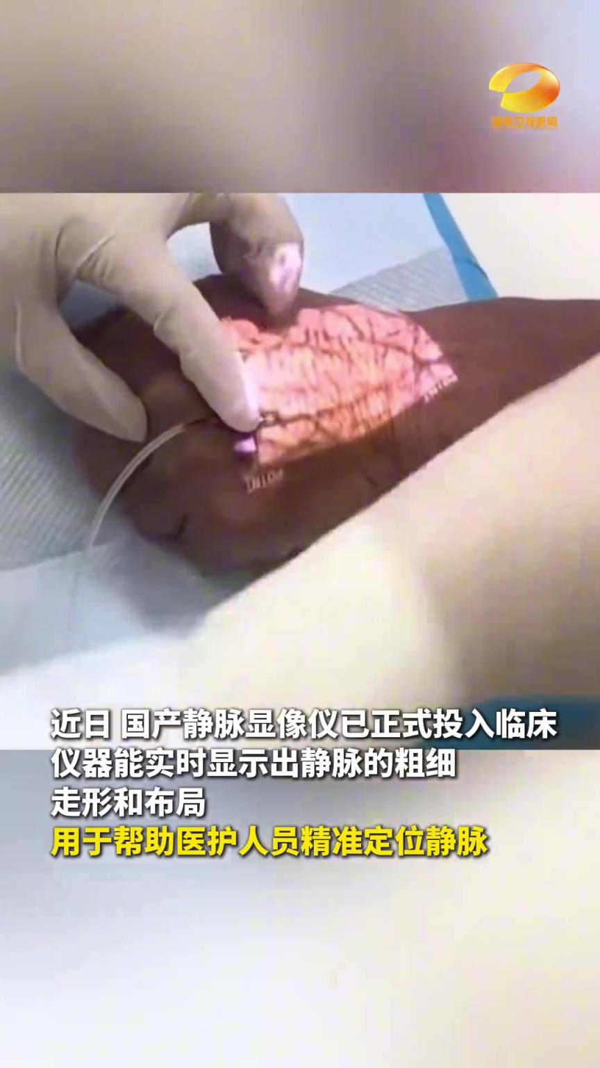 國產(chǎn)靜脈顯像儀投入臨床 1秒精準定位血管 再也不怕扎錯針了