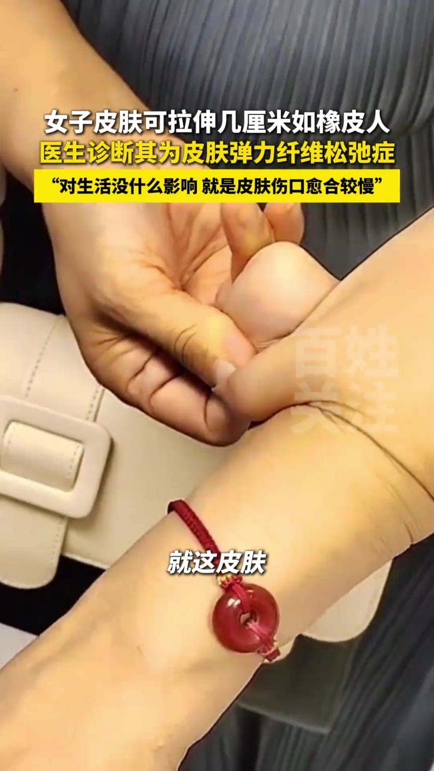 女子皮肤可拉伸几厘米如橡皮人