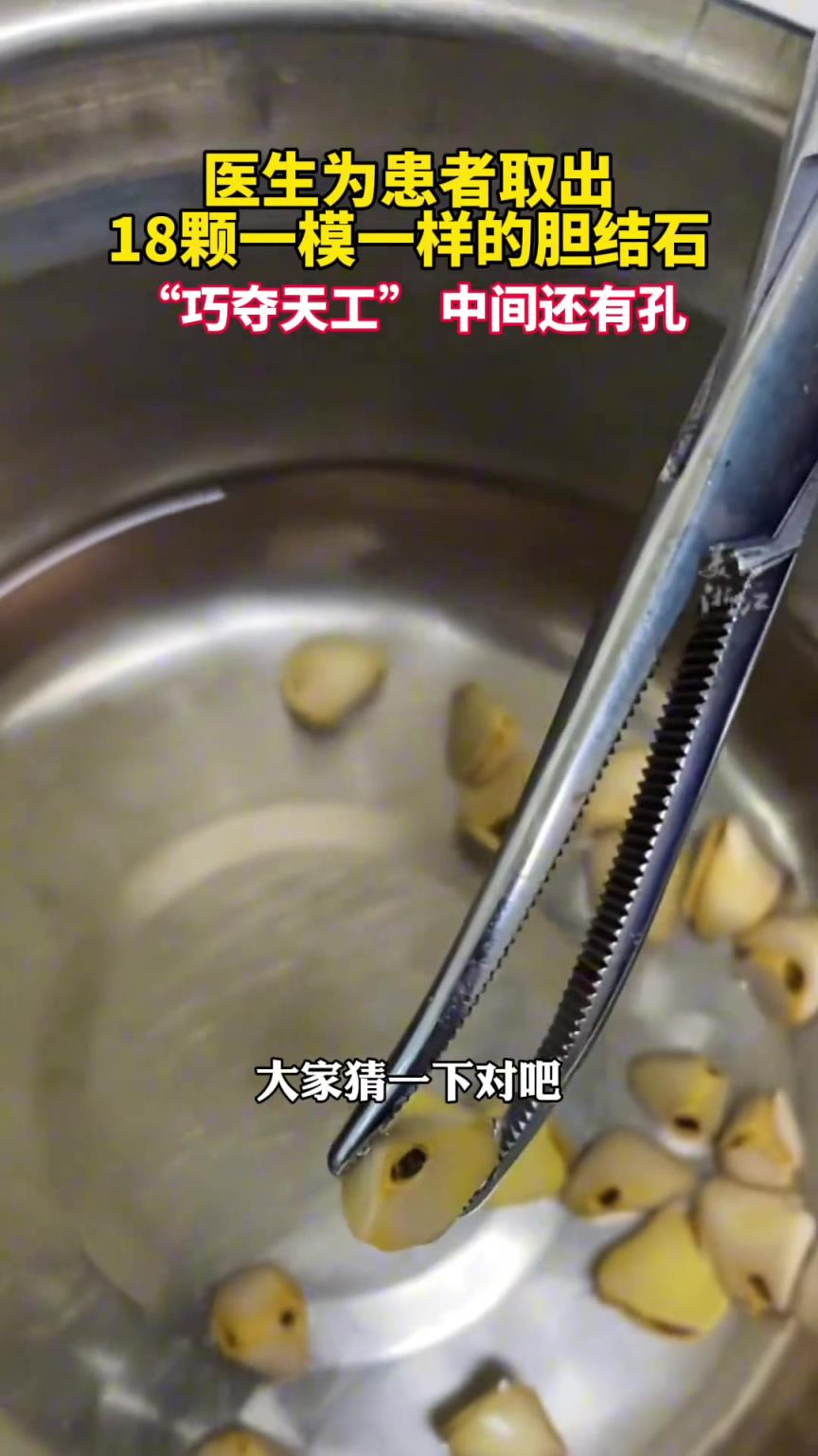 “巧夺天工”医生为患者取出18颗一模一样的胆结石。