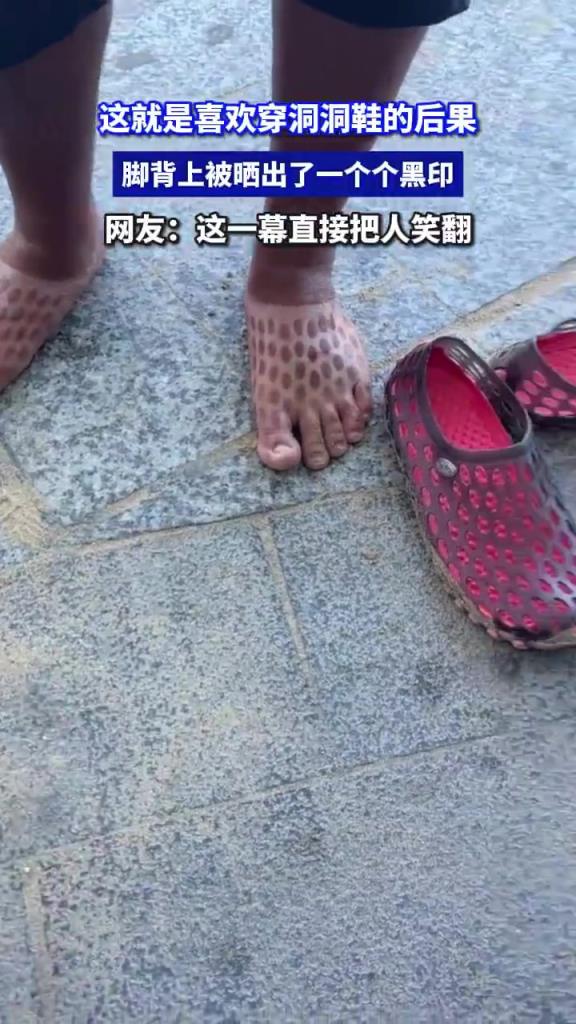 这就是喜欢穿洞洞鞋的后果 脚背上被晒出了一个个黑印