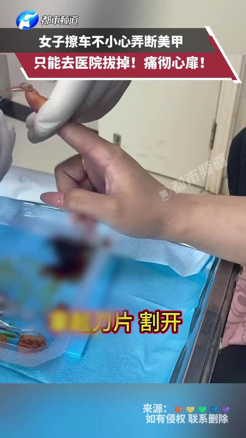 女子擦车不小心弄断美甲，只能去医院拔掉！痛彻心扉！