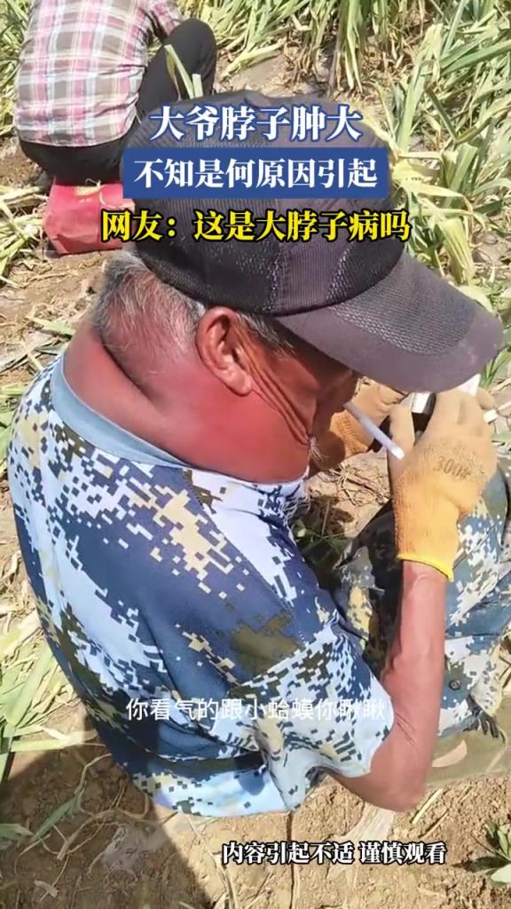 大爷脖子肿大,不知是何原因引起,网友:这是大脖子病吗!