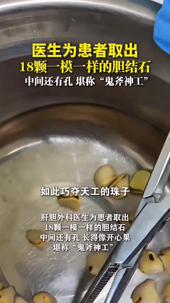 膽結(jié)石形狀奇特引調(diào)侃，網(wǎng)友：可作工藝品