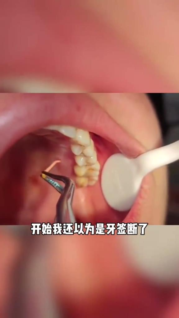 牙签折到里面了，这是什么情况，看着就疼！