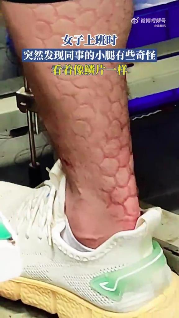女子上班时，突然发现同事的小腿有些奇怪，看着像鳞片一样