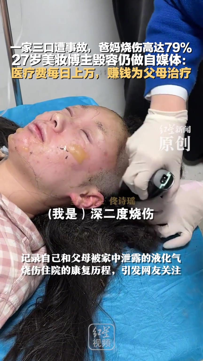 一家三口遭事故，爸妈烧伤，27岁美妆博主毁容仍做自媒体