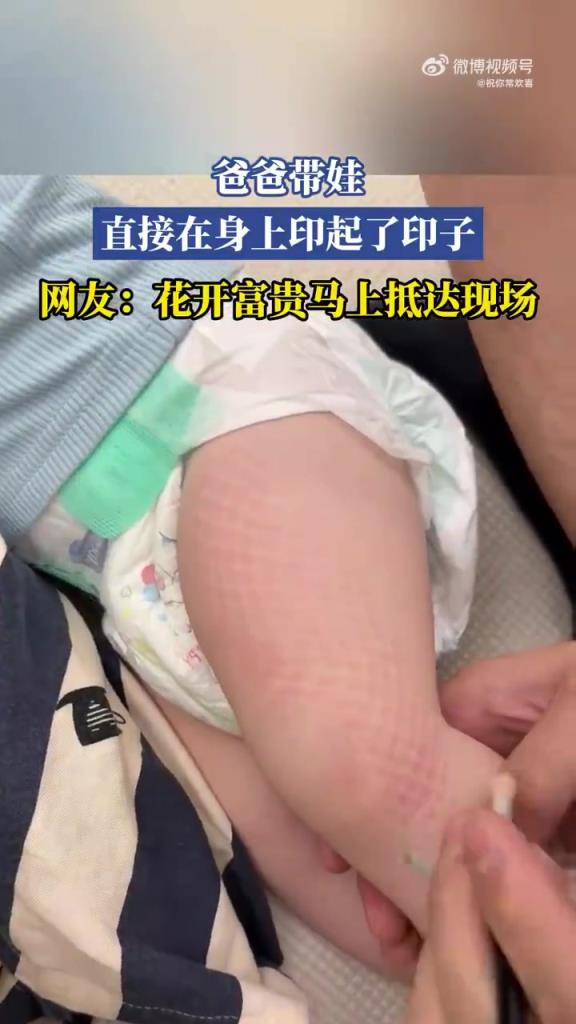 爸爸带娃，直接在身上印起了印子