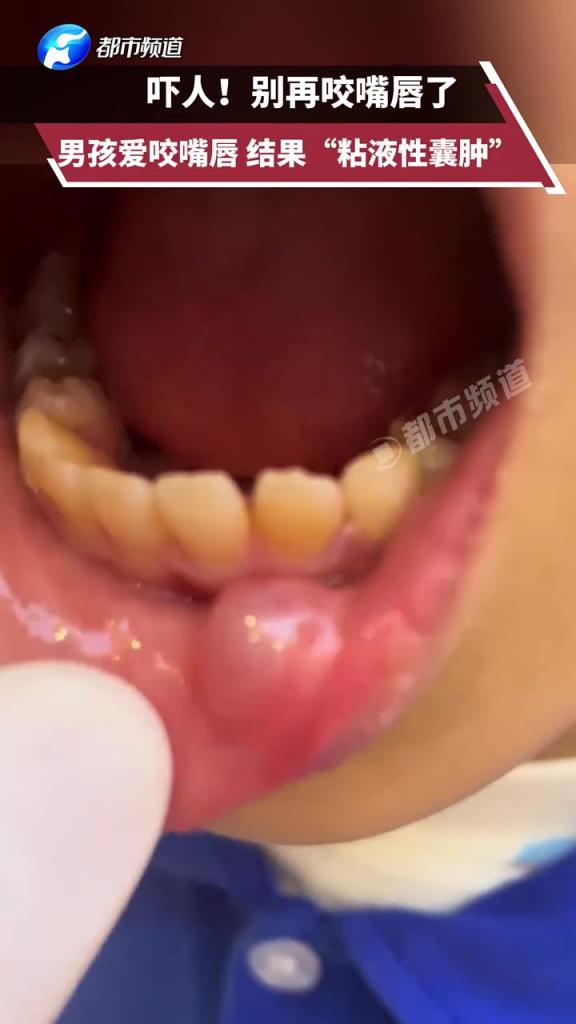 嚇人!別再咬嘴唇了男孩愛咬嘴唇 結(jié)果“粘液性囊腫”！
