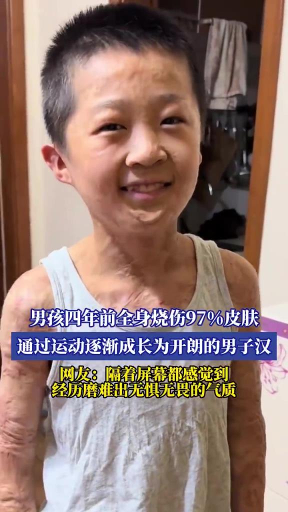 男孩 97% 燒傷后靠運動重生，蛻變成開朗男子漢