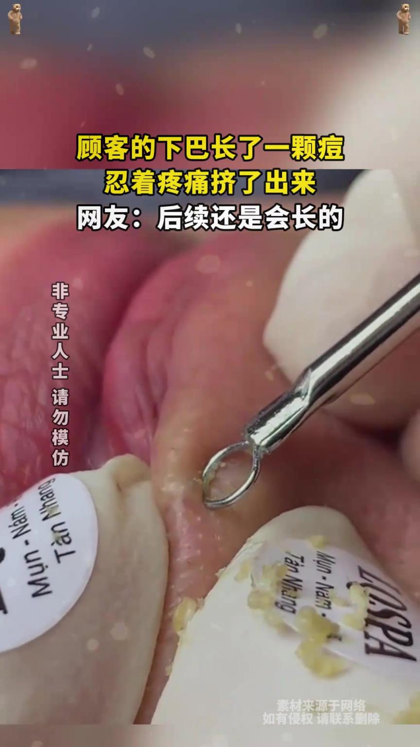 顾客的下巴长了一颗痘，忍着疼痛挤了出来，网友：后续还是会长的