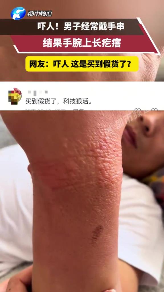 嚇人!男子經(jīng)常戴手串結(jié)果手腕上長疙瘩!!!