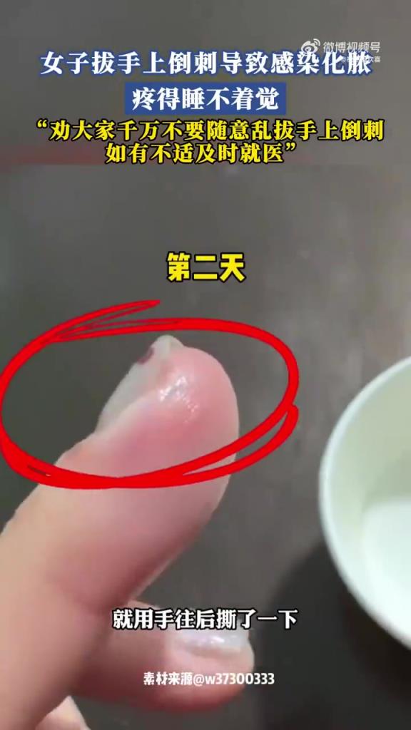 女子拔手上倒刺导致感染化脓