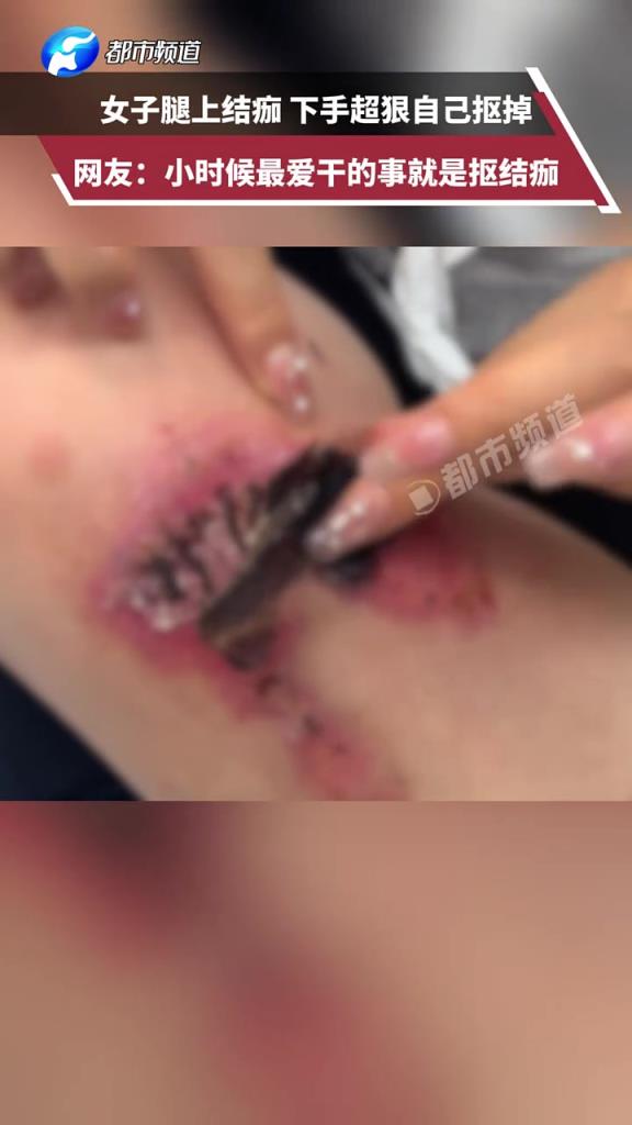 女子腿上结痂，下手超狠自己抠掉，小时候最爱干的事就是抠结痂