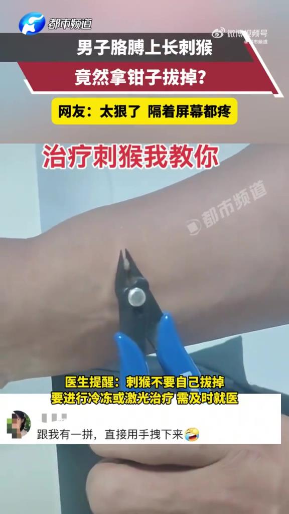 男子胳膊上长刺猴自己用钳子拔掉