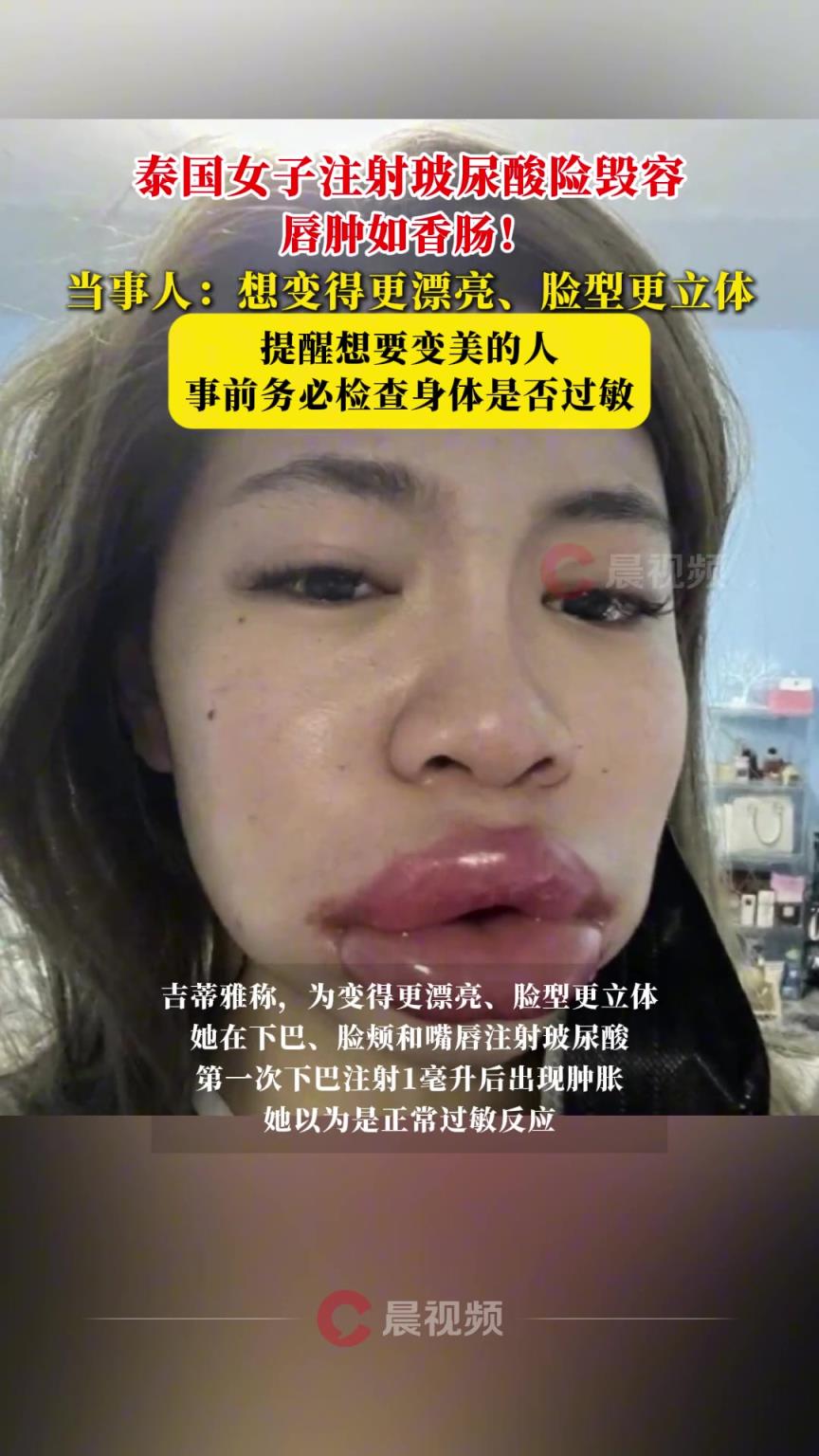 唇腫如香腸！泰國女子注射玻尿酸險毀容