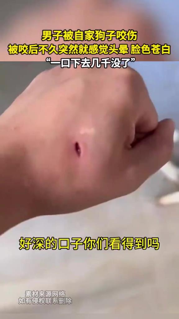 男子被自家狗子咬伤 被咬后不久突然就感觉头晕 脸色苍白