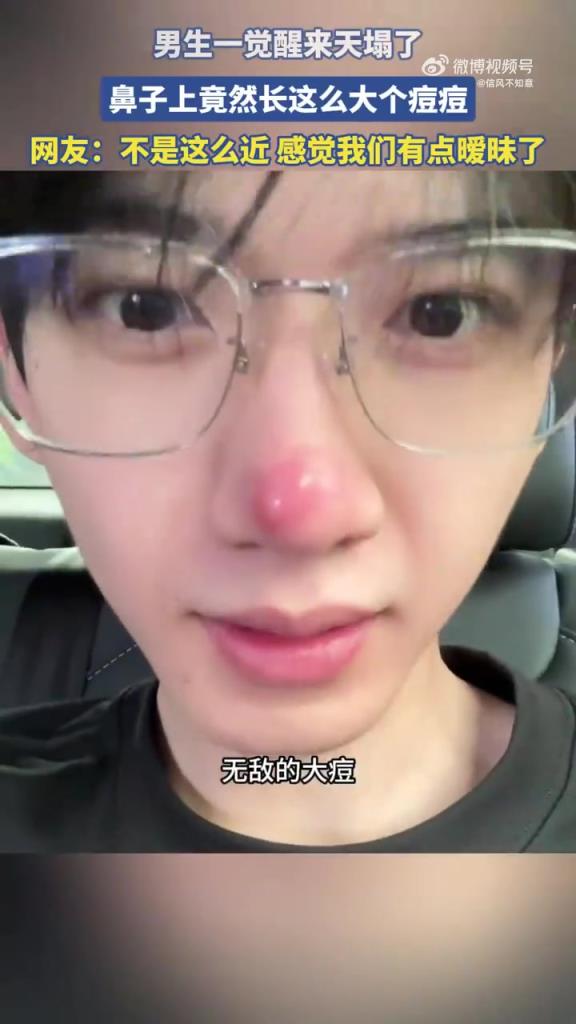 男生一覺醒來天塌了，鼻子上竟然長這么大個痘痘！