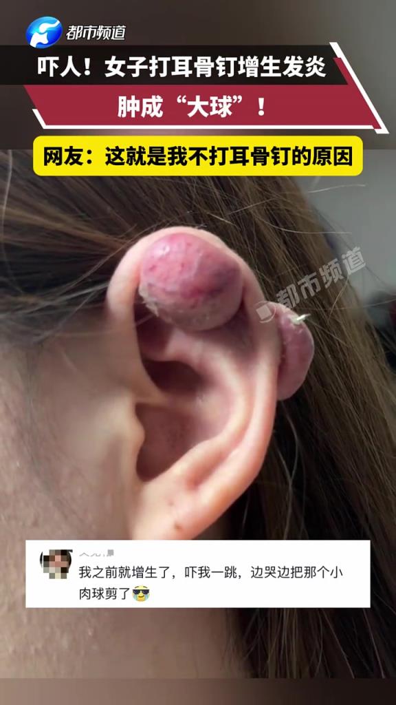 嚇人!女子打耳骨釘增生發(fā)炎，腫成“大球”!