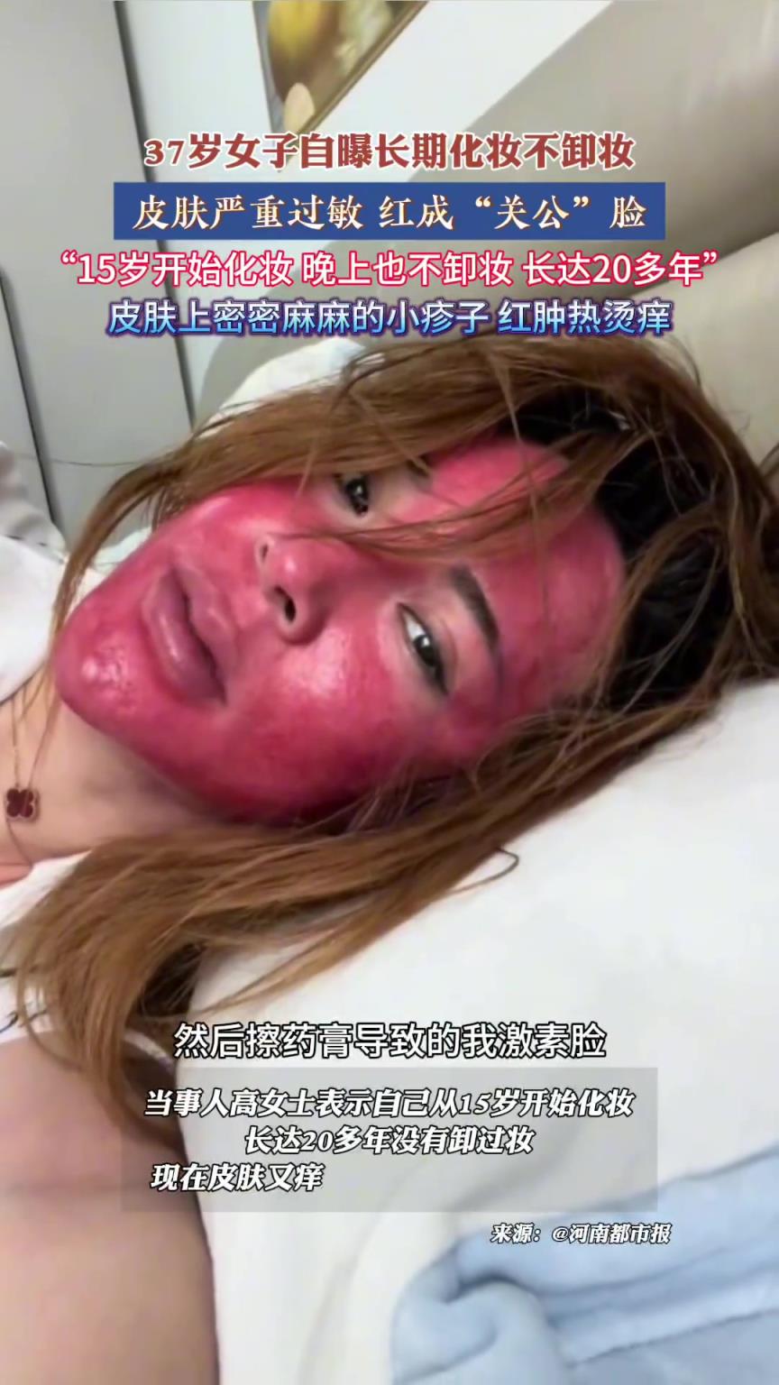 37岁女子自曝长期化妆不卸妆，皮肤严重过敏 红成“关公”脸