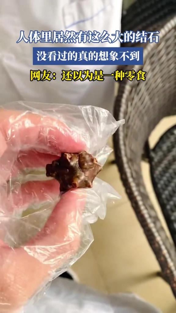 人体里居然有这么大的结石,没看过的真的想象不到!!