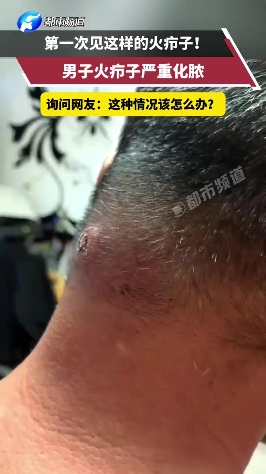 男子長(zhǎng)巨大火癤子嚴(yán)重化膿