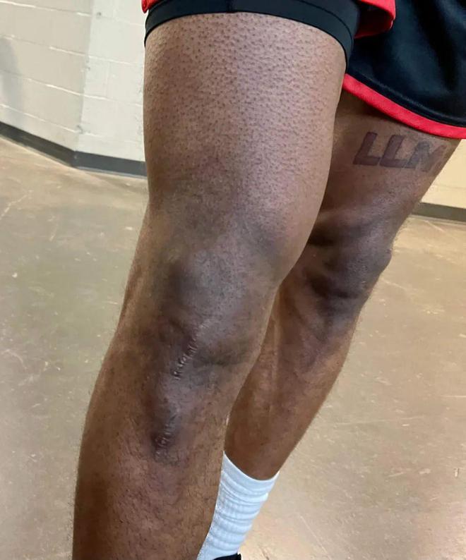 斷腿手術5次之后，他打進了NBA