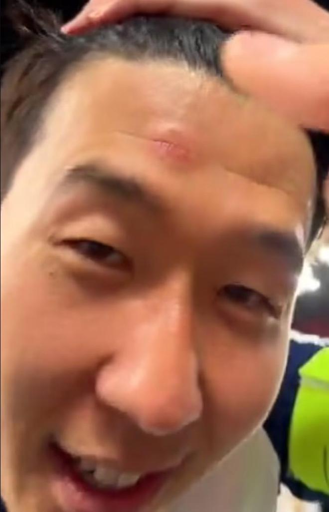 孙兴慜庆祝的时候把额头撞在了奖杯上，导致轻微擦伤