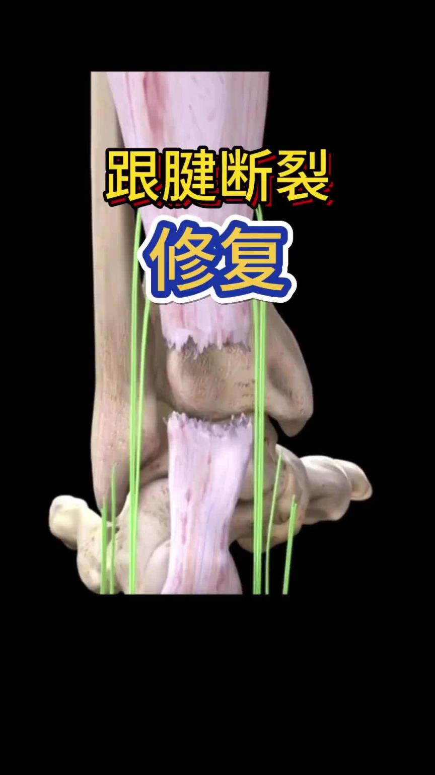 看着都疼啊！科普帖：球员脚跟腱断裂是如何进行修复的？